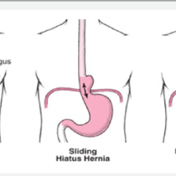 Hernia diaphragmatic congenital ray pulmonary repair left lateral loops right anterior bilateral hypoplasia laparoscopic without figure colonic herniated chest showing