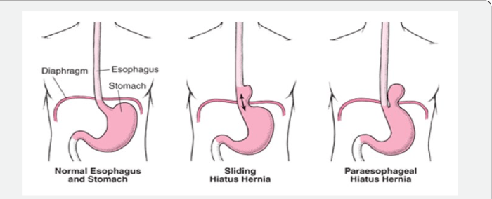 Hernia diaphragmatic congenital ray pulmonary repair left lateral loops right anterior bilateral hypoplasia laparoscopic without figure colonic herniated chest showing