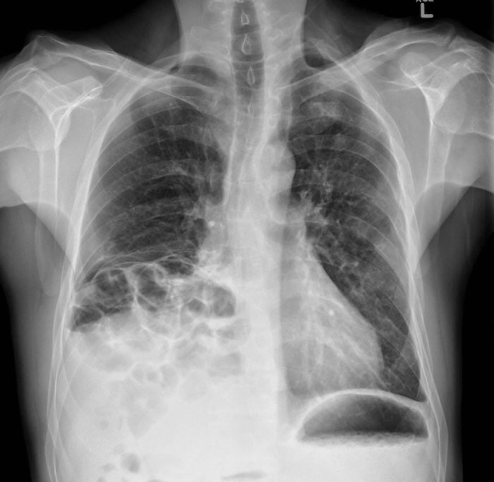 Cpt code diaphragmatic hernia repair