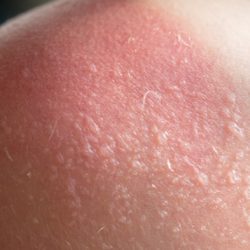 Welding sunburn risks