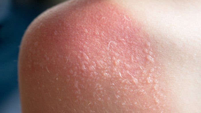 Welding sunburn risks