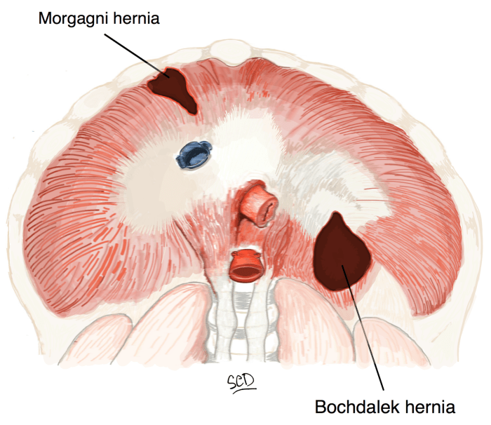 Cpt code diaphragmatic hernia repair